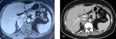 Xanthogranulomatous Adrenalitis: A Case Report and Literature Review